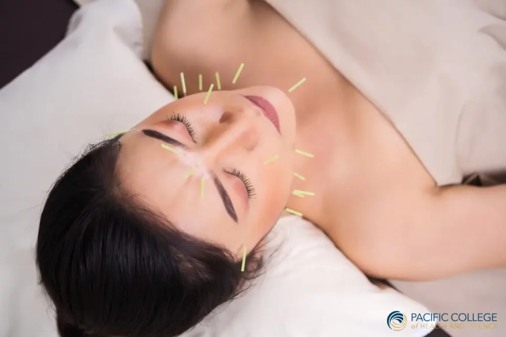 facial acupuncture